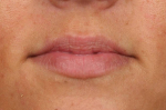 Lip Augmentation Case 85 Before